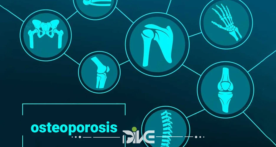  پوکی استخوان (اوستئوپورز؛osteoporosis) چیست